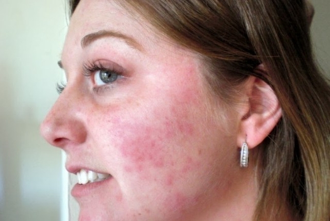Красные пятна на лице при аллергии