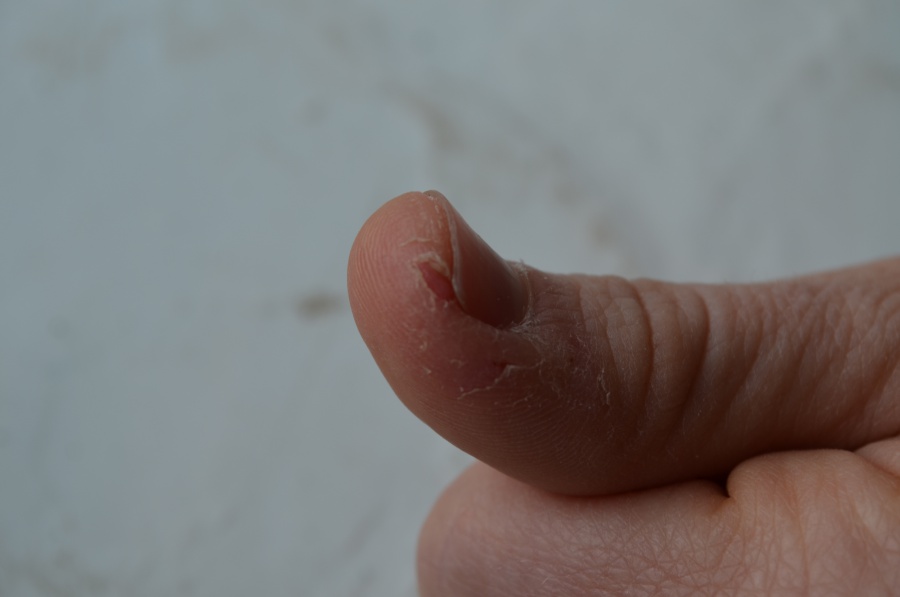 Что делать если кожа вокруг ногтей сухая и трескается. Трещины на пальцах — причины